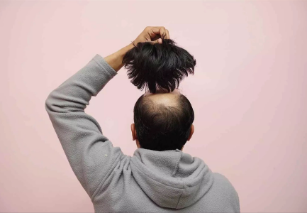 Cosmetic Hair System - Non-surgical hair solution